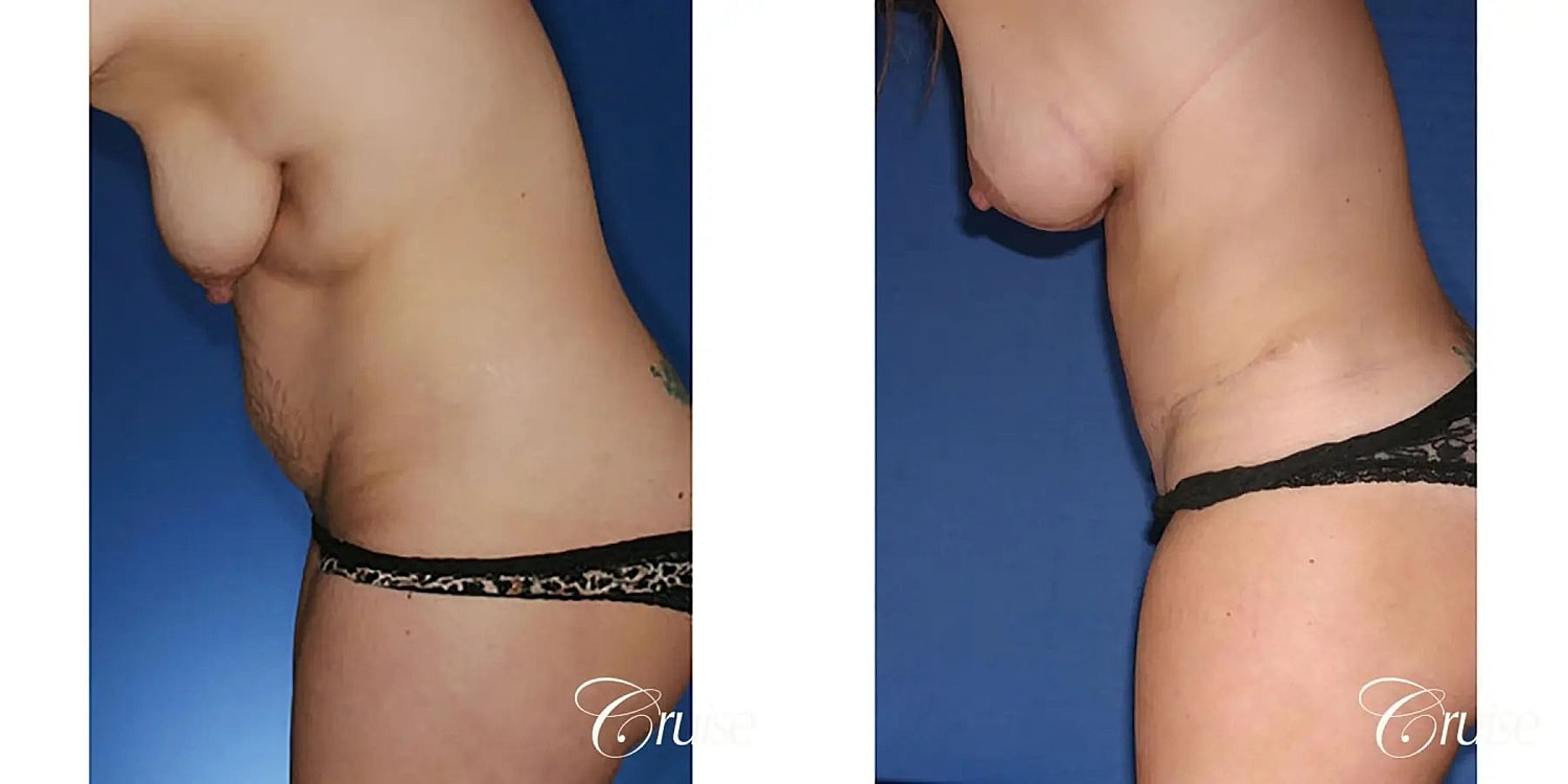 Mommy Makeover Before & After