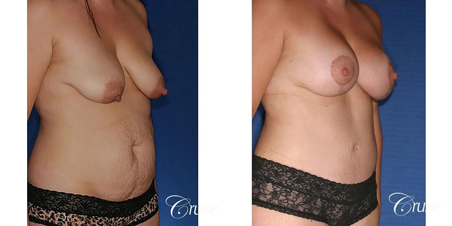 Mommy Makeover Before & After