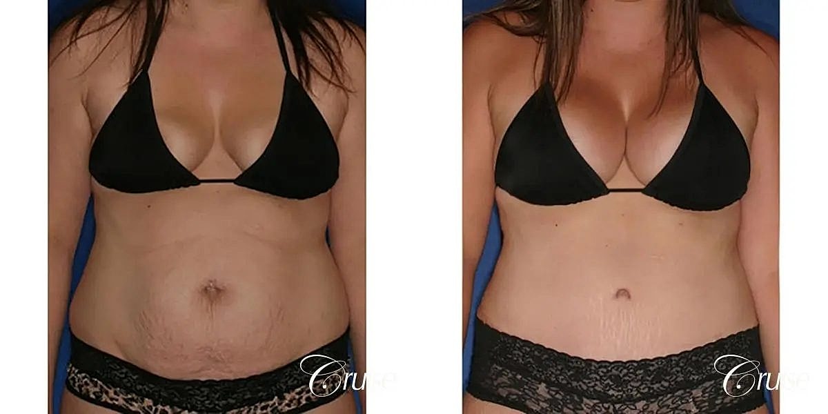 Mommy Makeover Before & After
