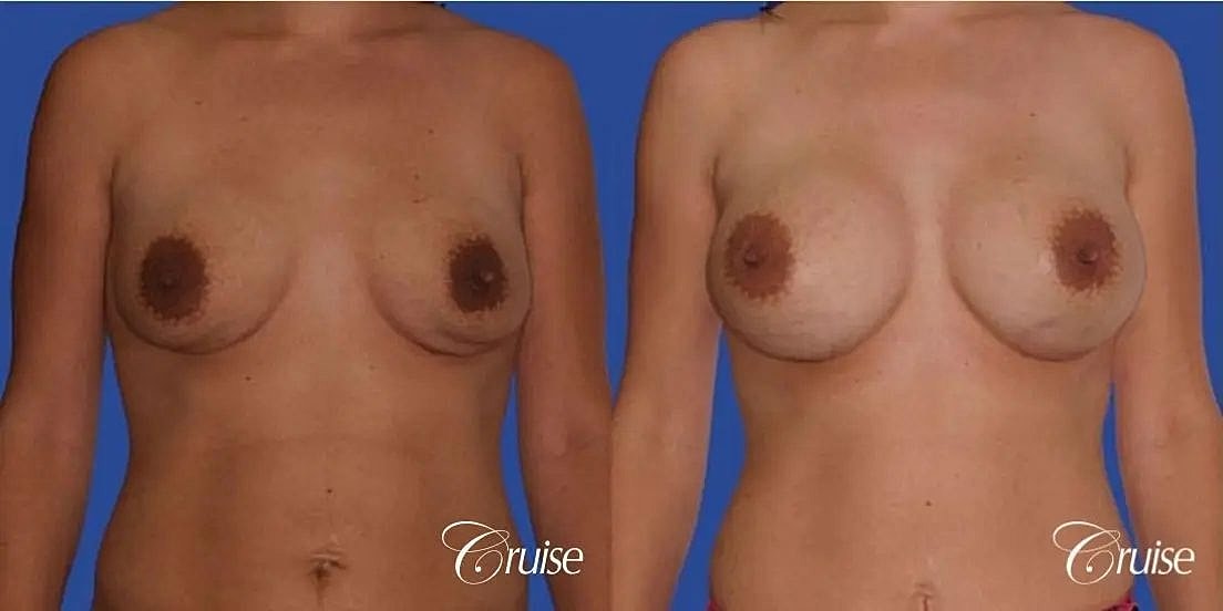 Mommy Makeover Before & After