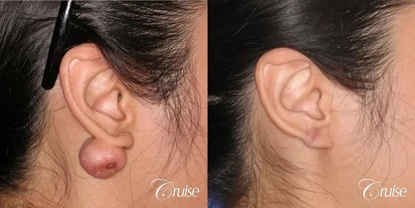 Scar Revision Before & After