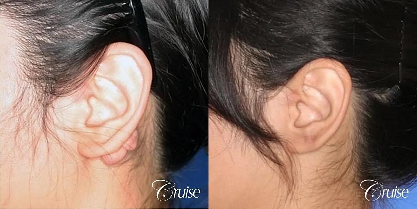 Scar Revision Before & After