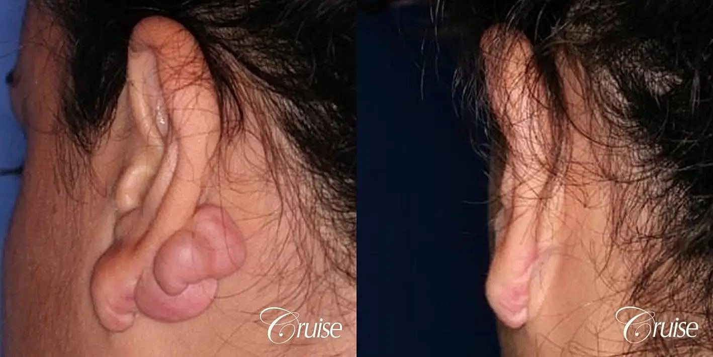 Scar Revision Before & After