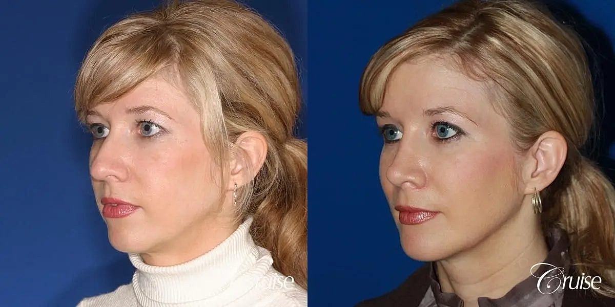 Chin Augmentation Before & After