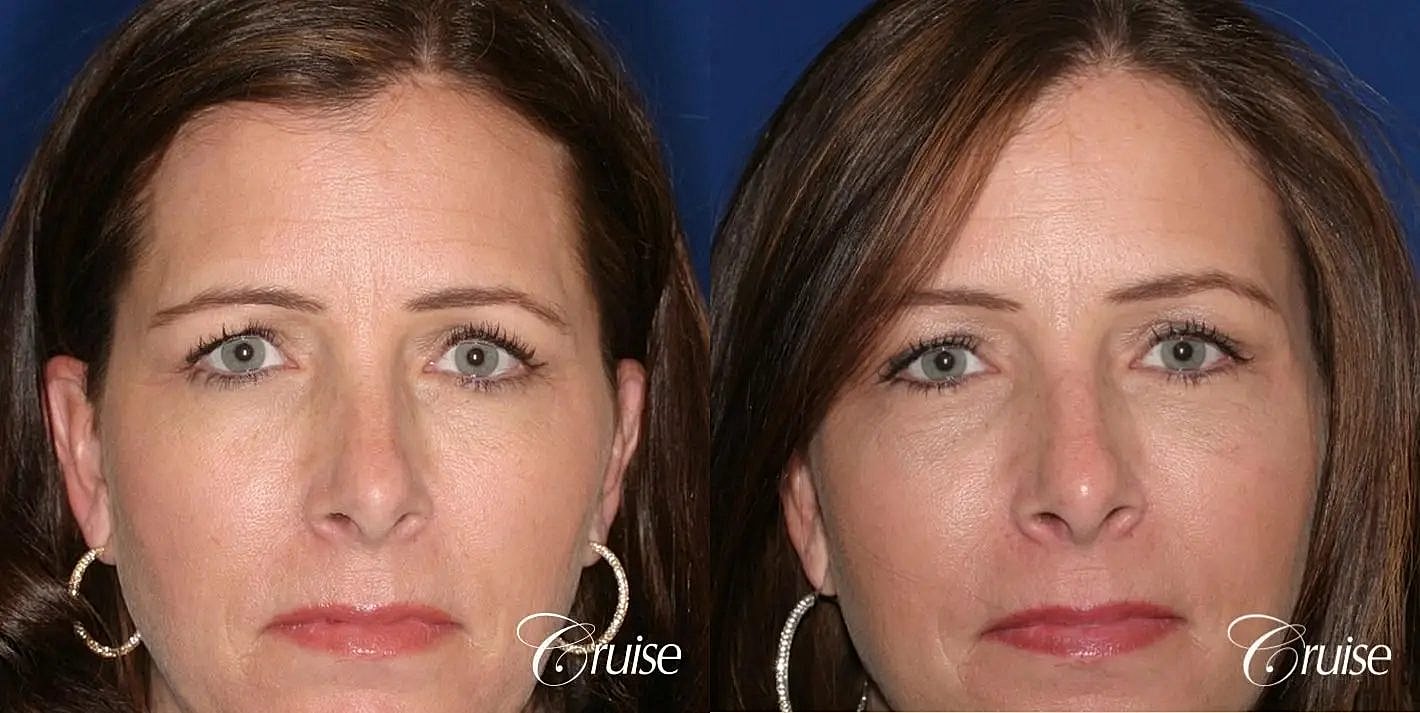 Brow Lift Before & After