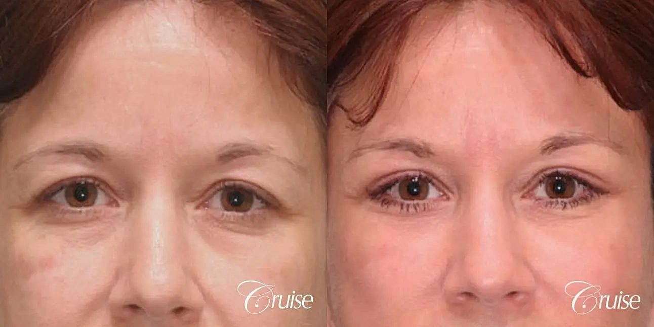 Brow Lift Before & After