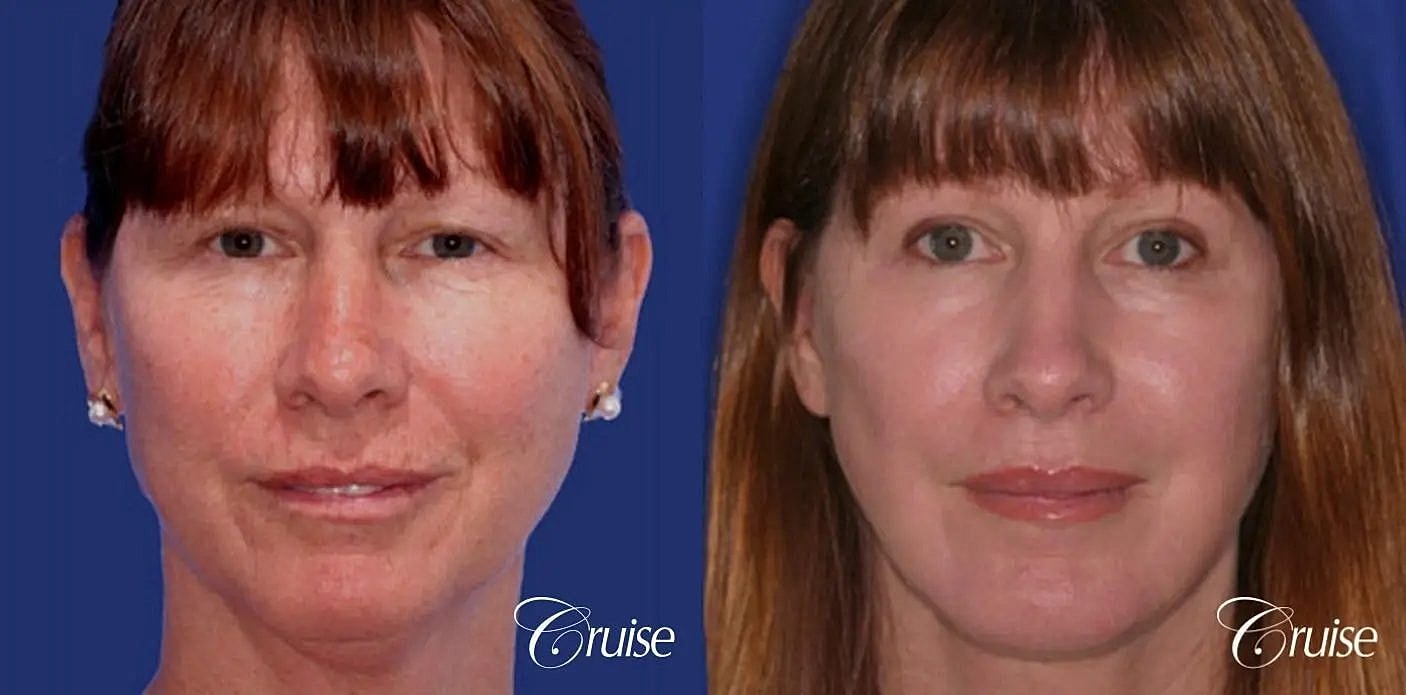 Brow Lift Before & After
