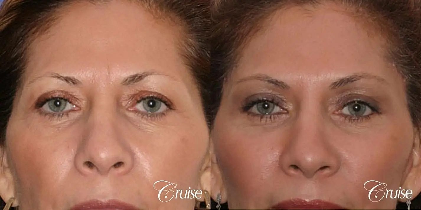 Brow Lift Before & After