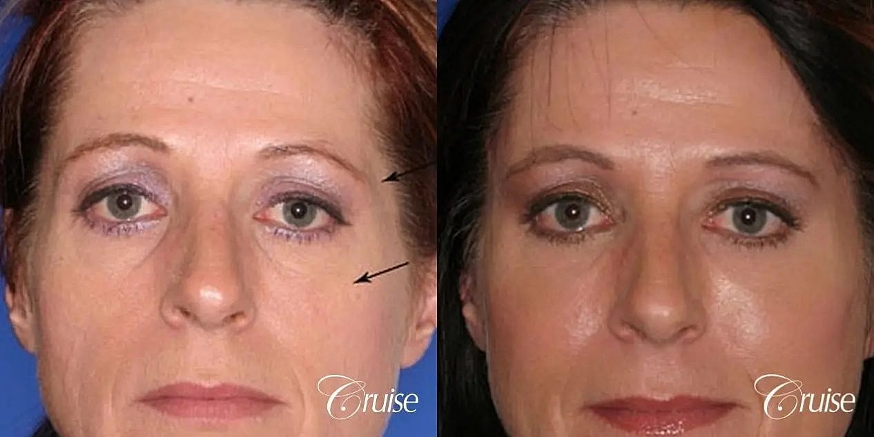 Brow Lift Before & After