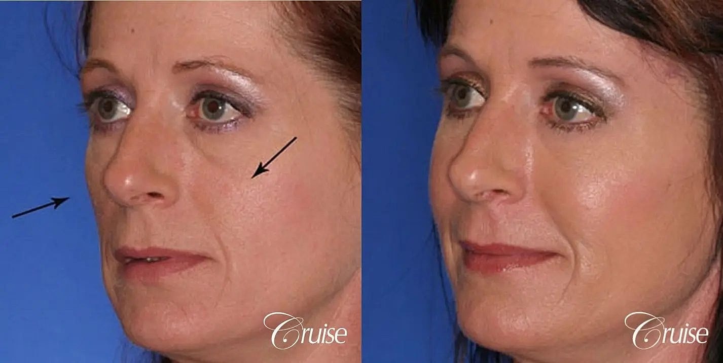 Brow Lift Before & After
