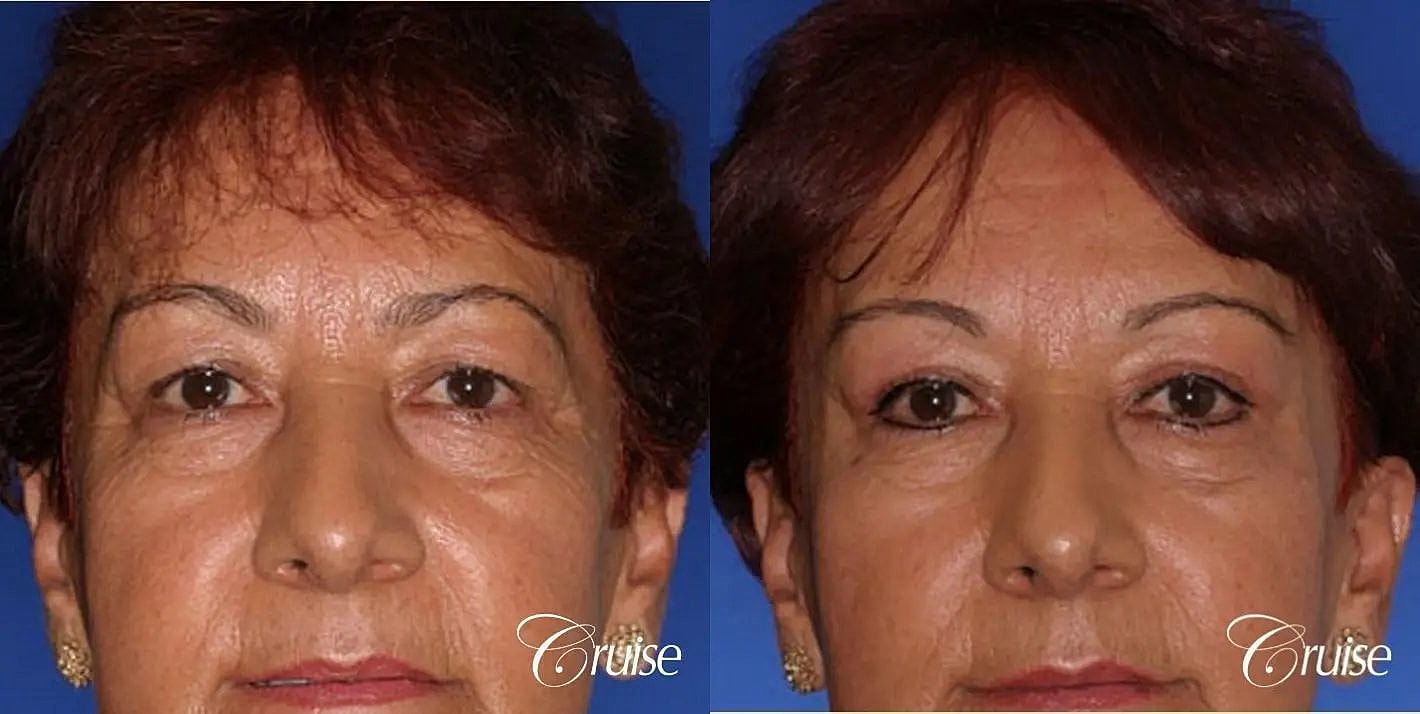 Brow Lift Before & After