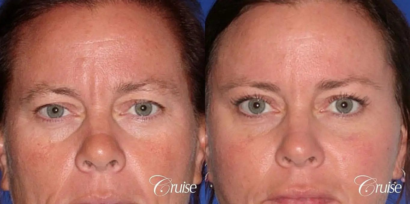 Brow Lift Before & After