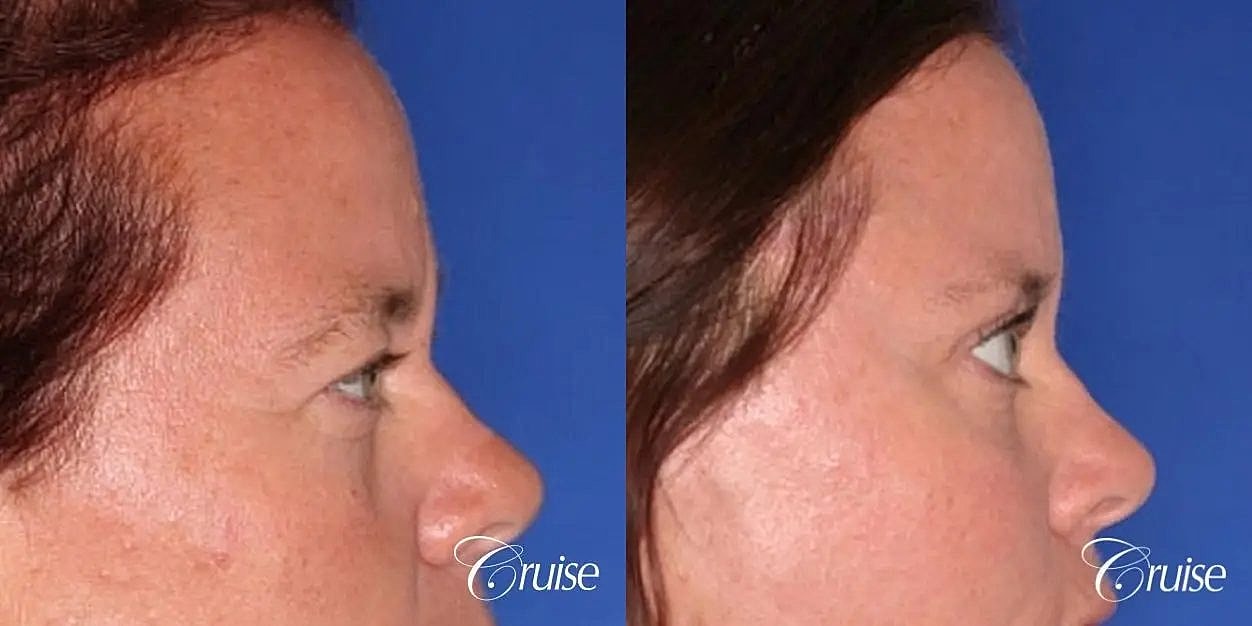 Brow Lift Before & After