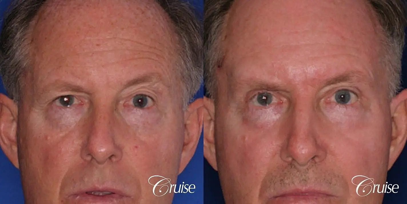 Brow Lift Before & After