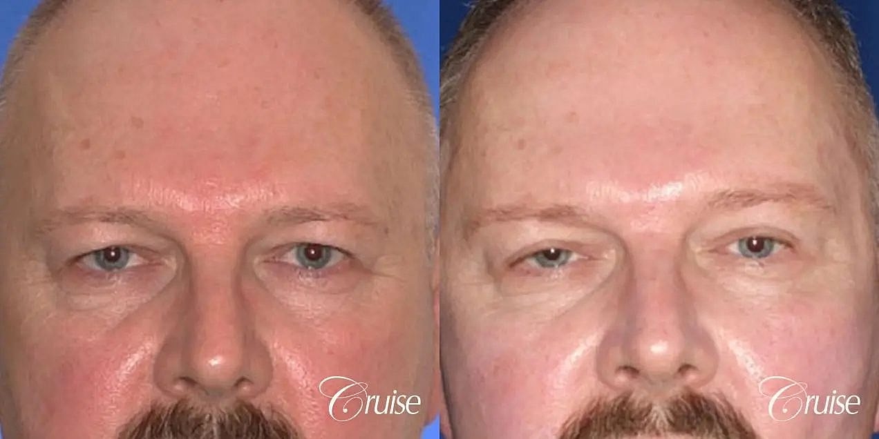 Brow Lift Before & After
