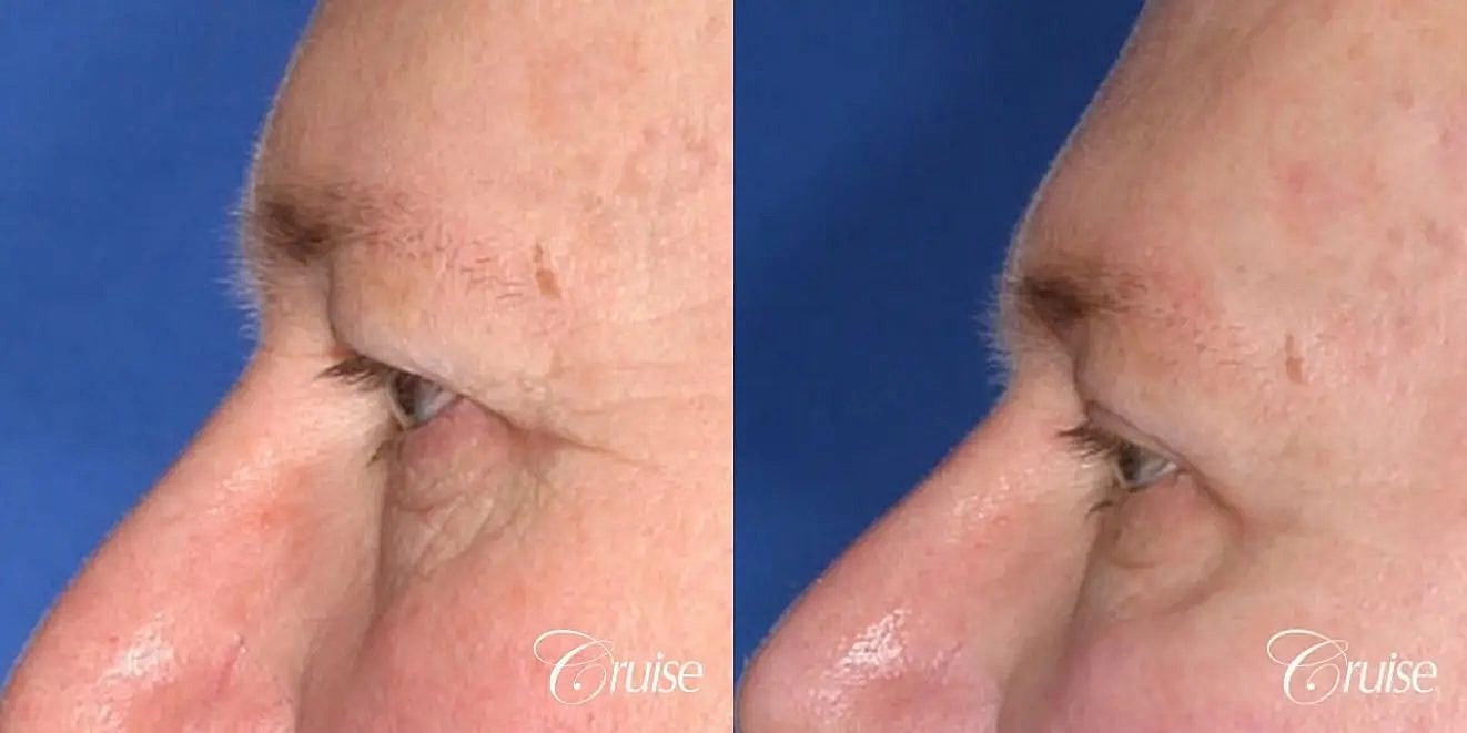 Brow Lift Before & After