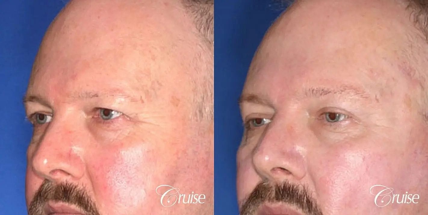 Brow Lift Before & After