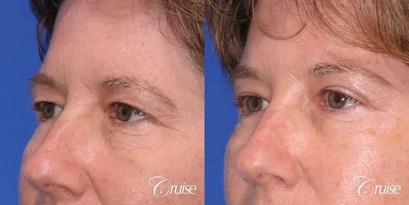 Brow Lift Before & After