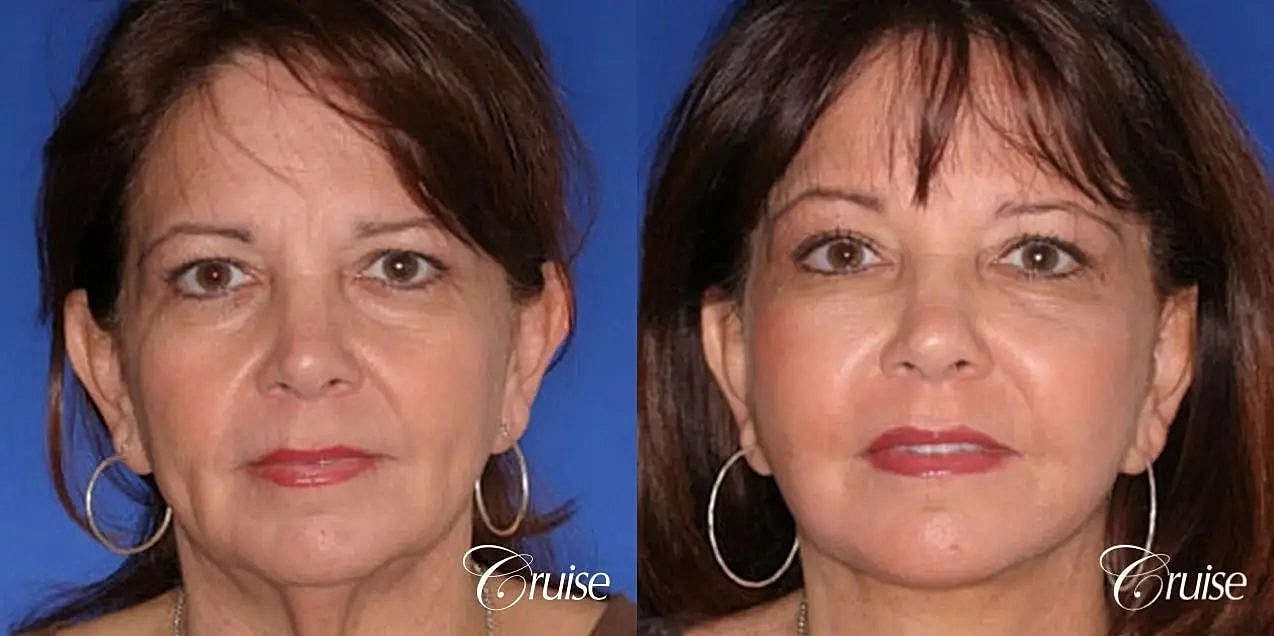 Brow Lift Before & After