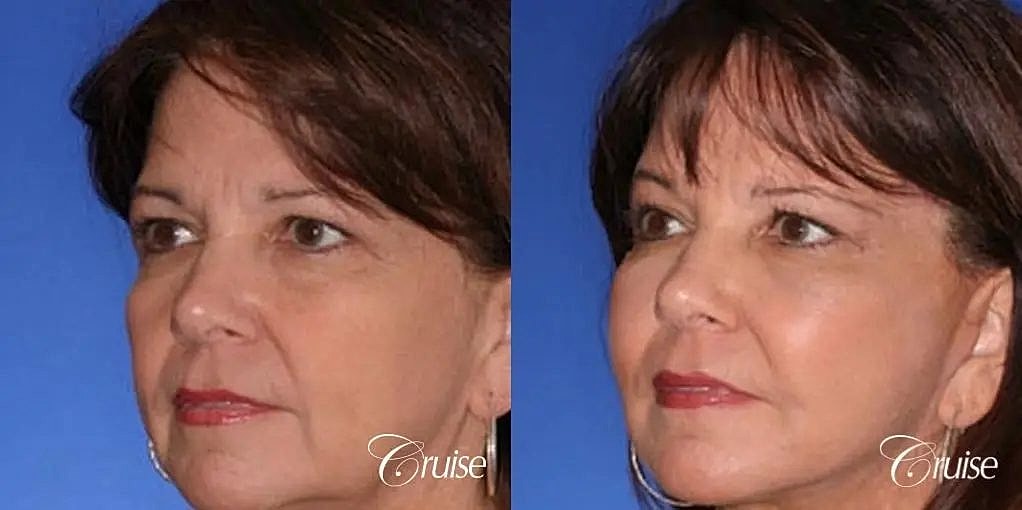 Brow Lift Before & After