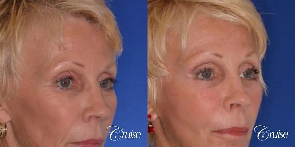 Brow Lift Before & After