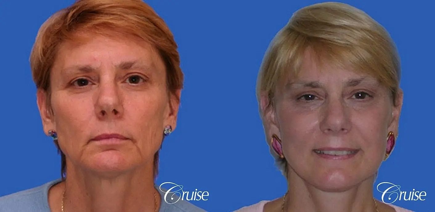 Brow Lift Before & After
