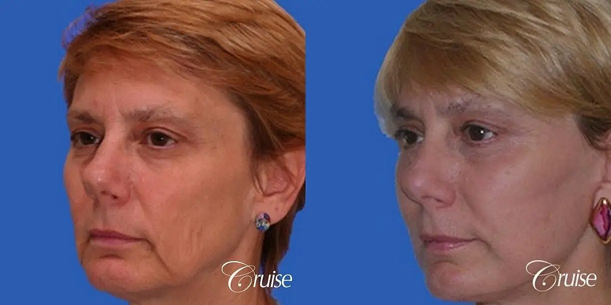 Brow Lift Before & After