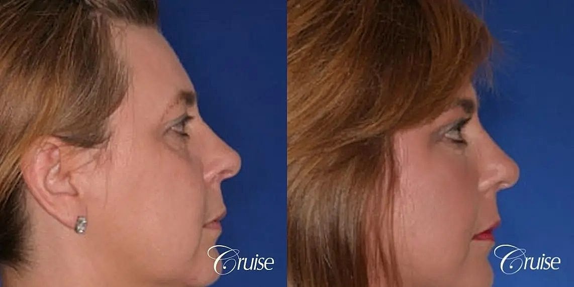 Brow Lift Before & After
