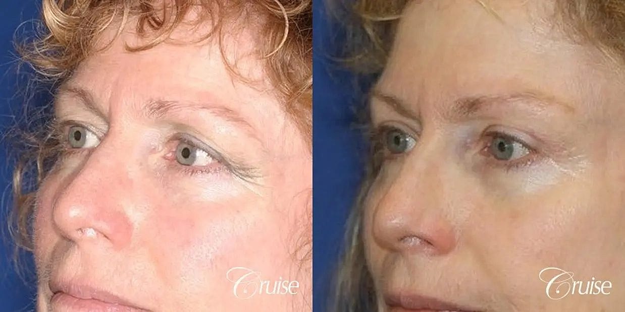 Brow Lift Before & After