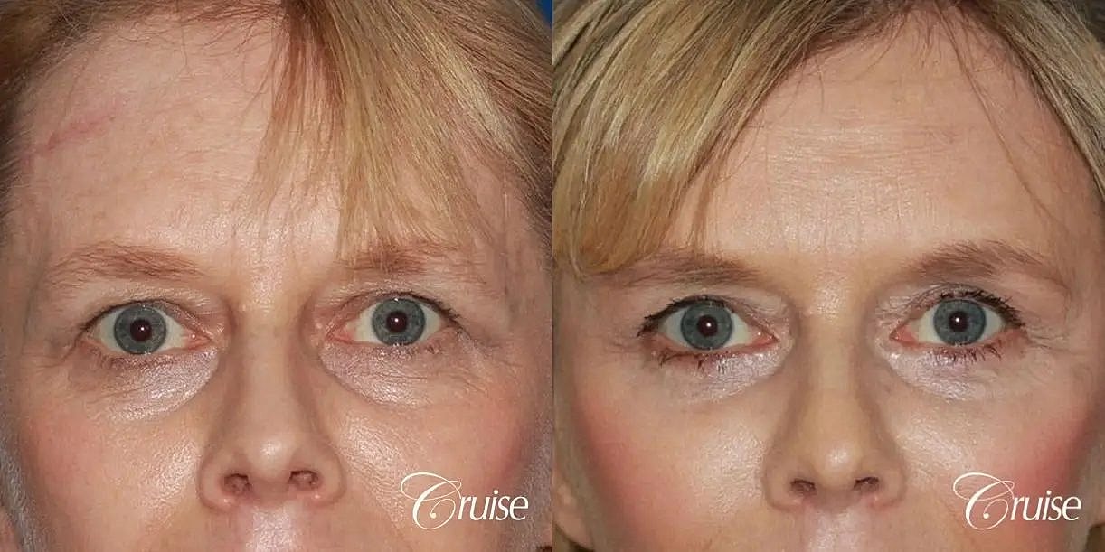 Brow Lift Before & After