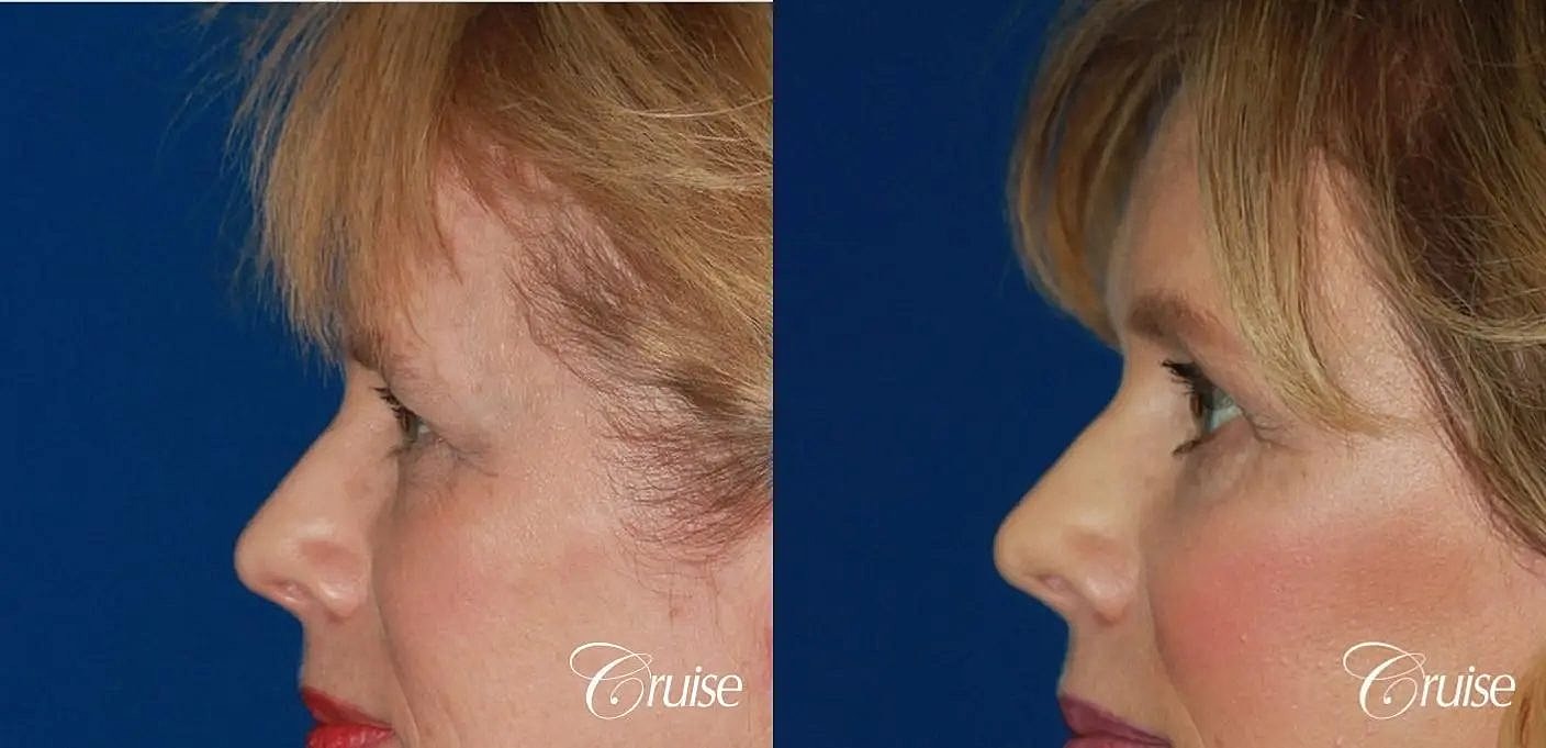 Brow Lift Before & After