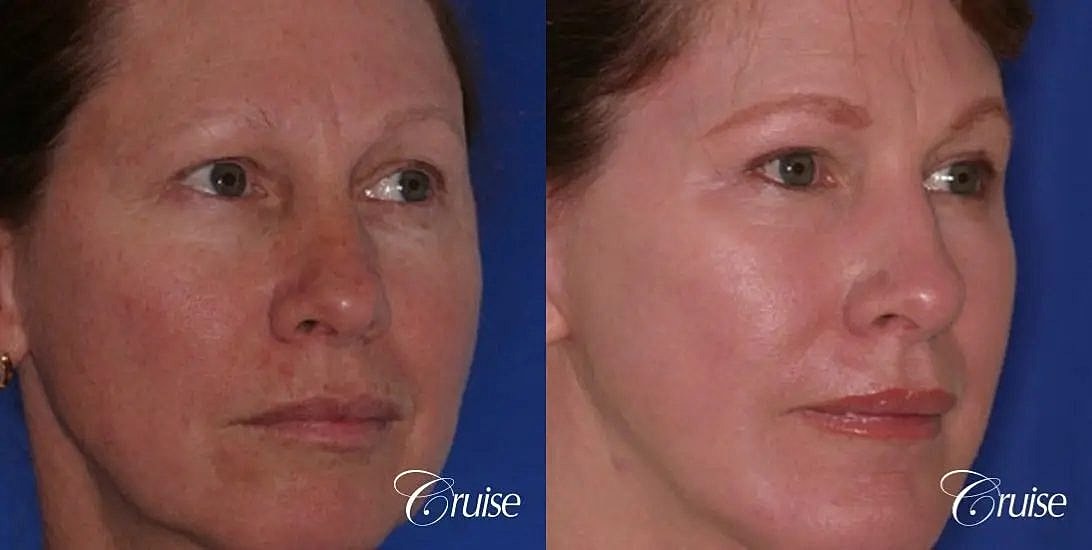 Chemical Peel Before & After