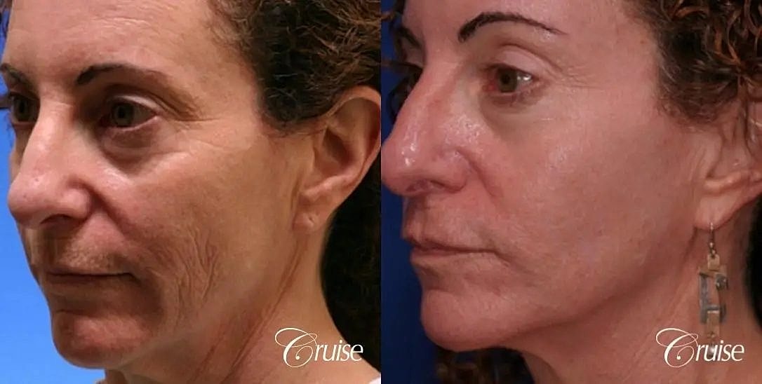 Chemical Peel Before & After