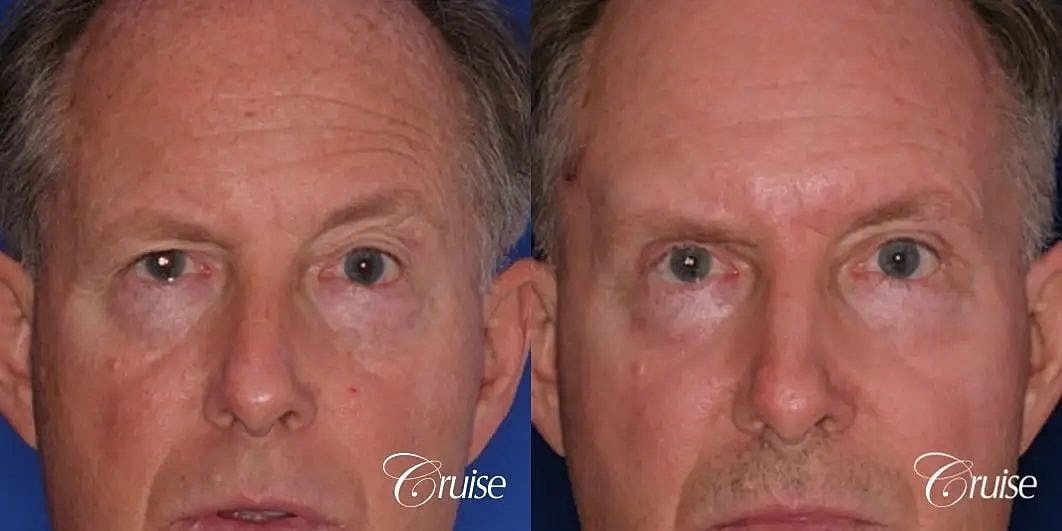 Chemical Peel Before & After