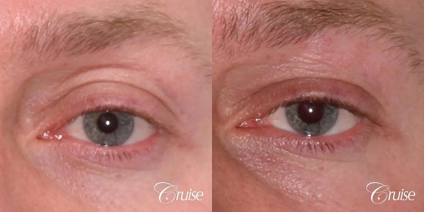 Dermal Fillers Before & After