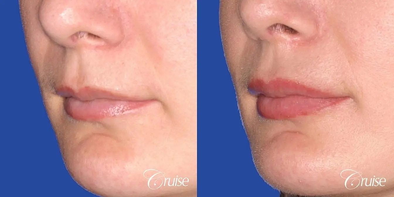 Dermal Fillers Before & After