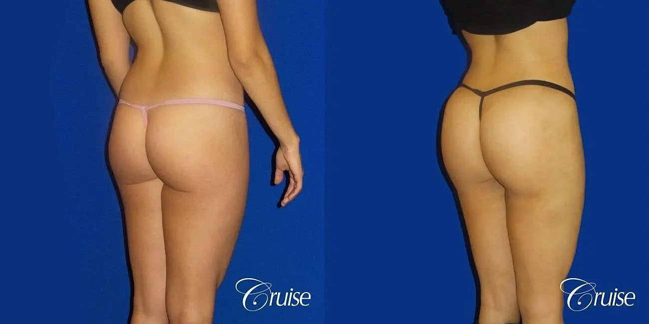 Brazilian Butt Lift Before & After