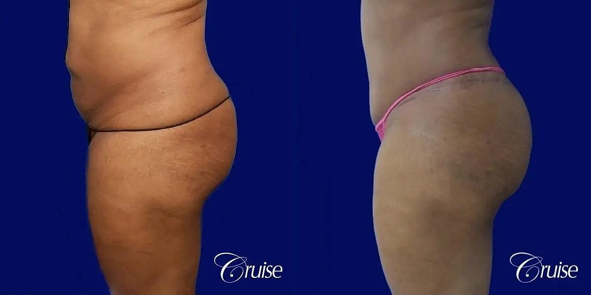 Brazilian Butt Lift Before & After