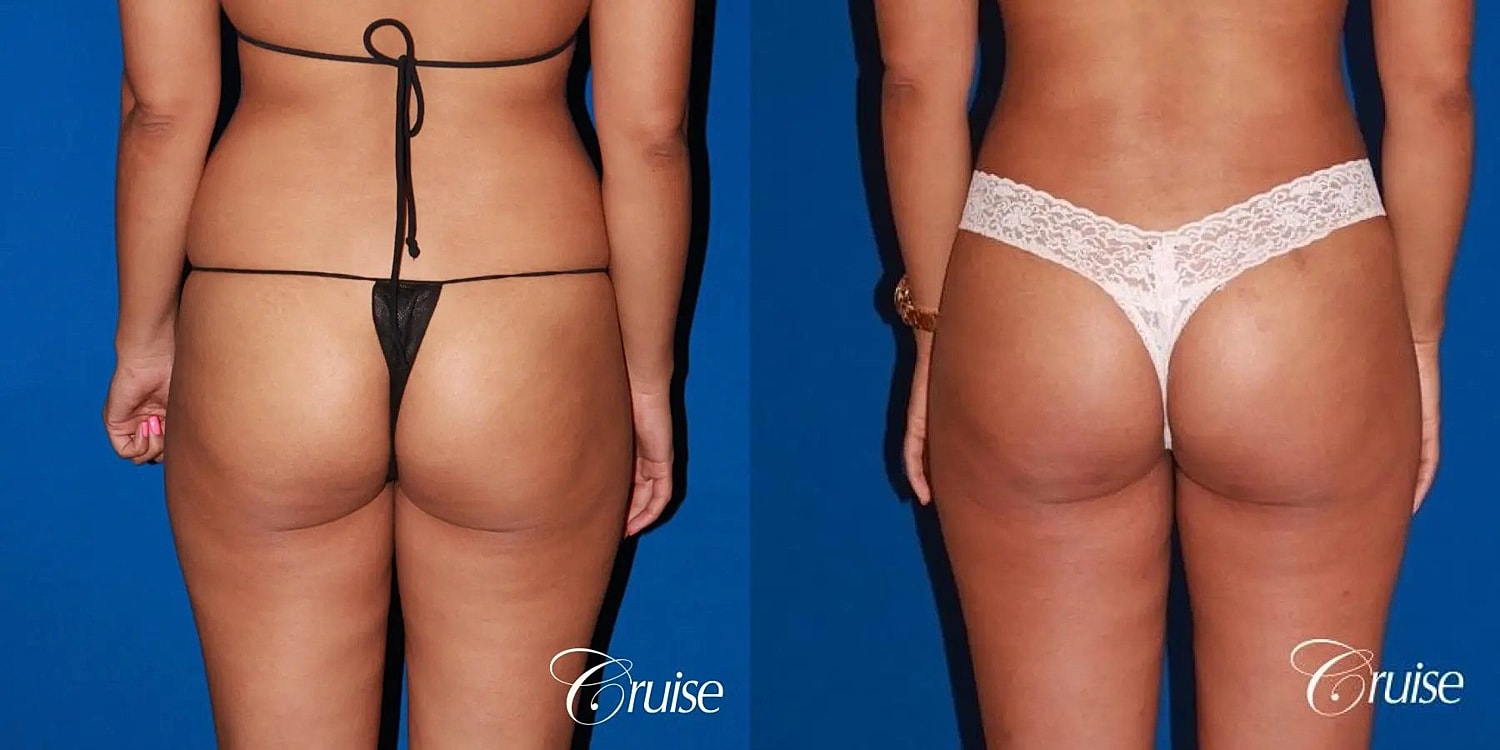 Brazilian Butt Lift Before & After