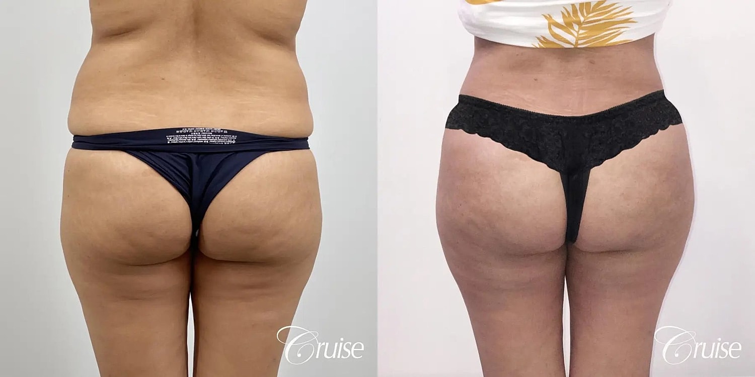 Brazilian Butt Lift Before & After
