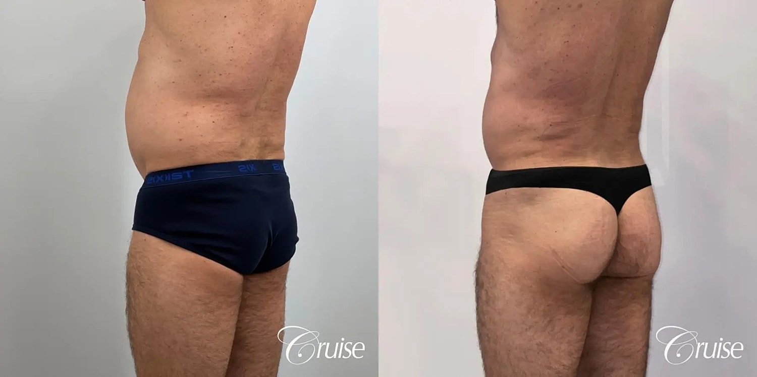 Brazilian Butt Lift Before & After