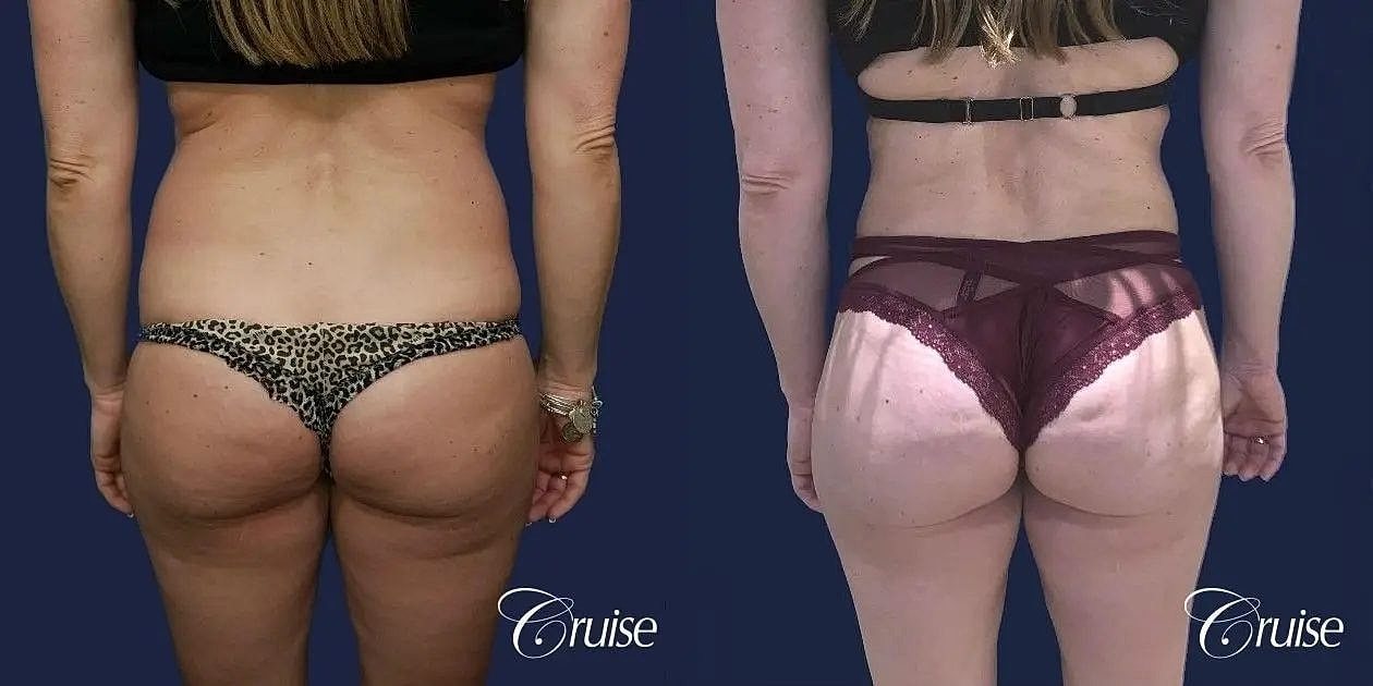 Brazilian Butt Lift Before & After
