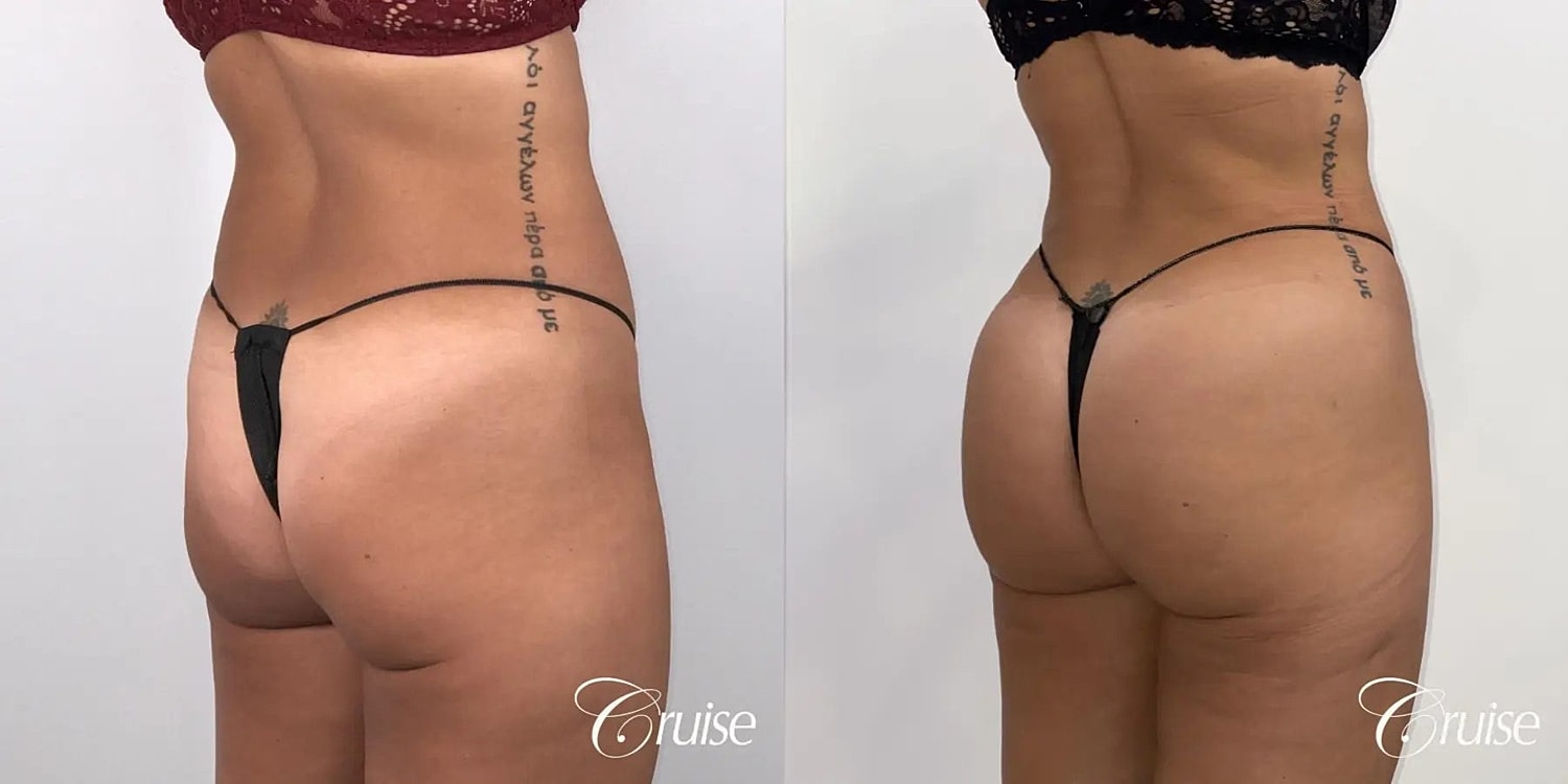 Brazilian Butt Lift Before & After