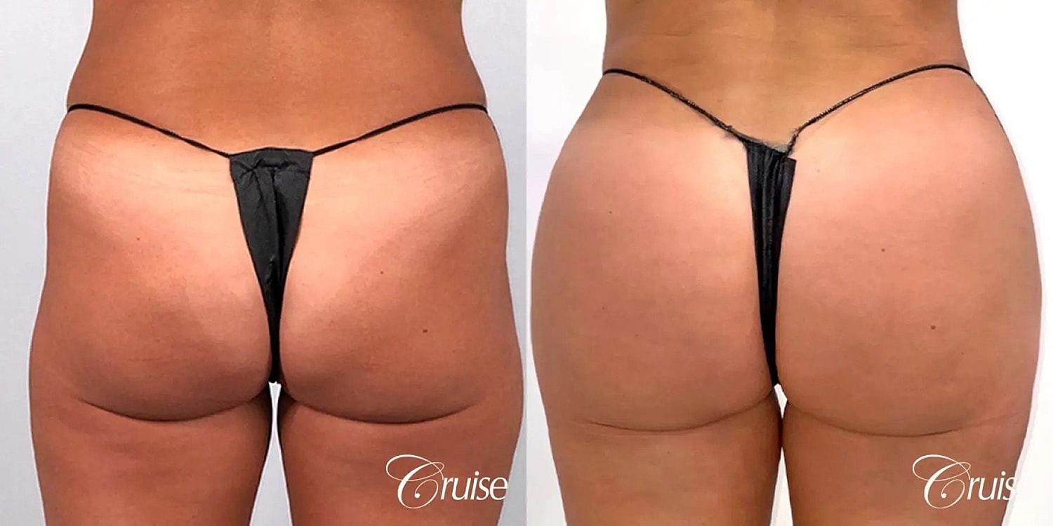 Brazilian Butt Lift Before & After
