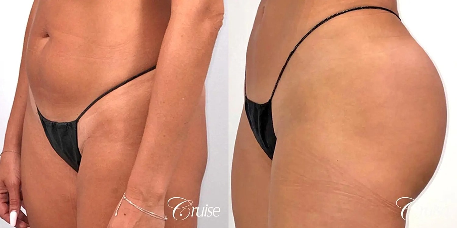 Brazilian Butt Lift Before & After