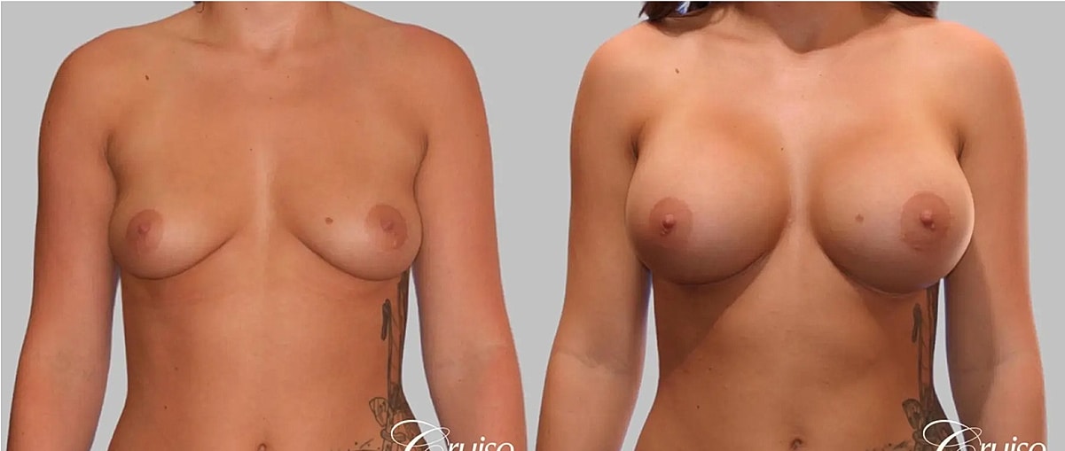  Before & After