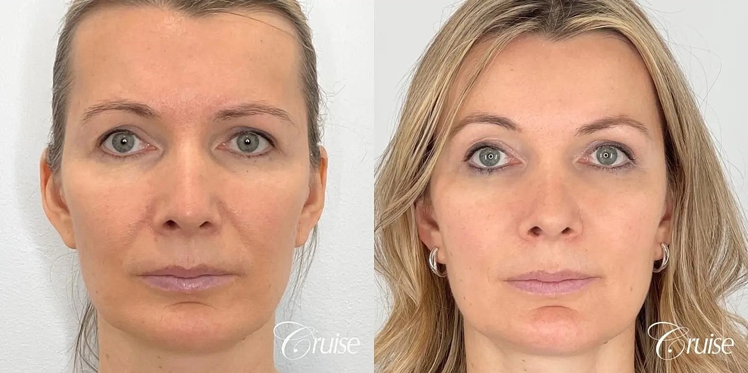 Facial Fat Transfer Before & After