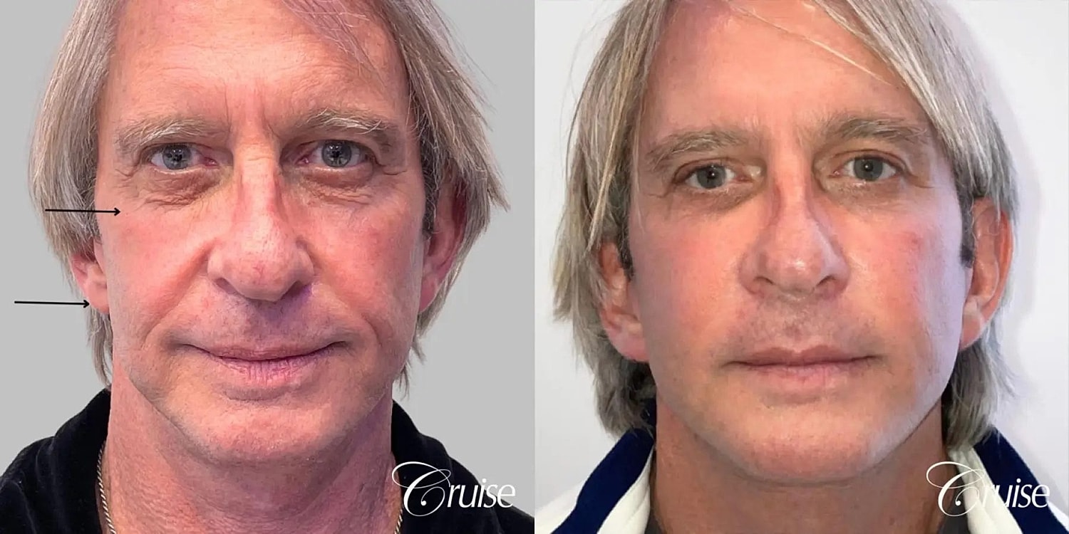 Facial Fat Transfer Before & After