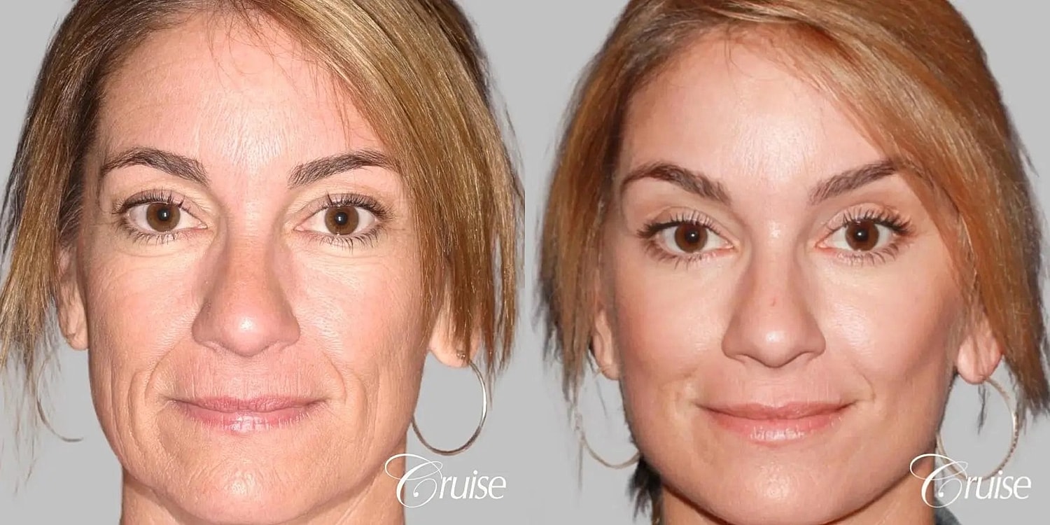 Facial Fat Transfer Before & After