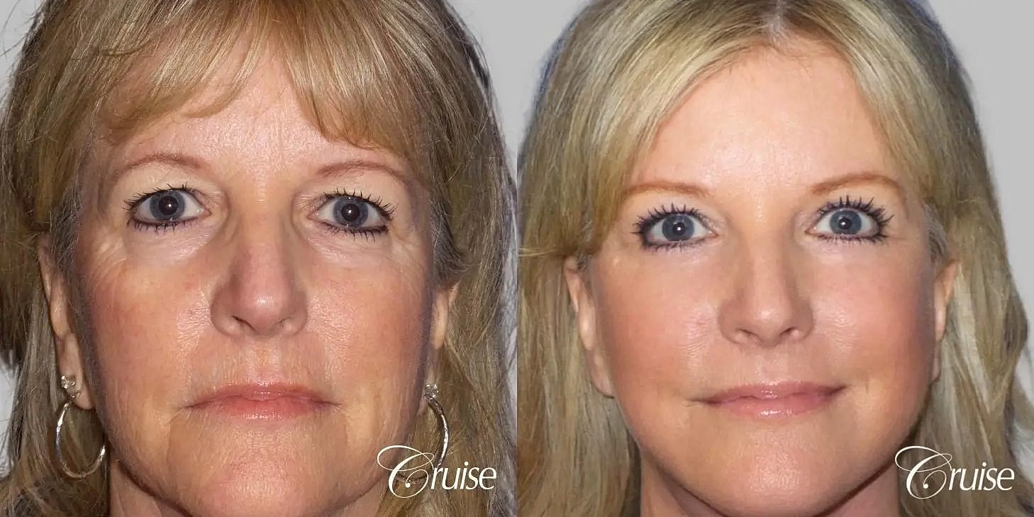 Facial Fat Transfer Before & After